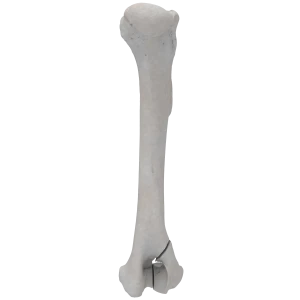 Humerus - Canine - Fracture 13-B1 acc. to AOVet
